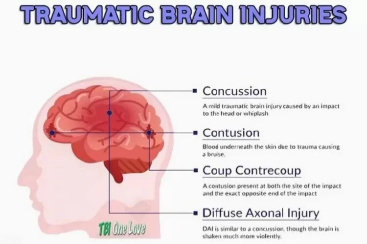 Most Common Types of Brain Injuries After Car Accidents