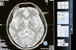 Long-Term Effects and Treatment of Traumatic Brain Injury (TBI)